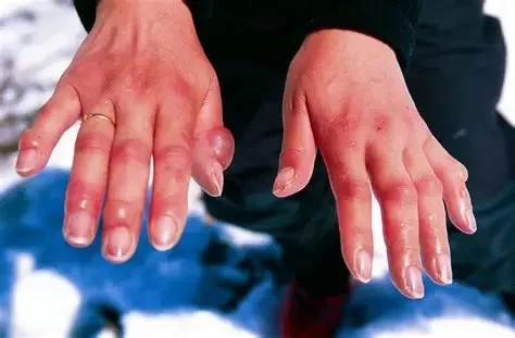 How to Deal with Frostbite on Hands and Feet Safely and Effectively