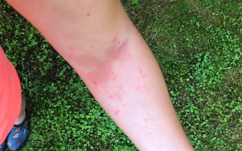 How to Deal with Allergic Reactions to Poison Ivy While Camping