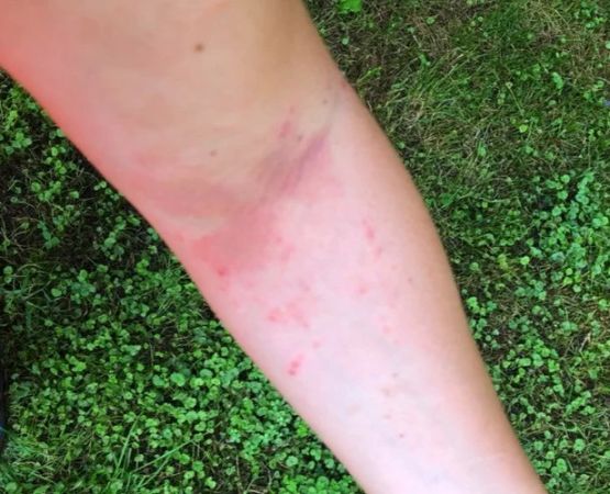 How to Deal with Allergic Reactions to Poison Ivy While Camping
