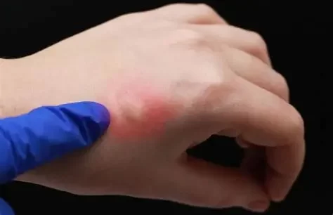 How to Deal with Allergic Reactions to Insect Bites