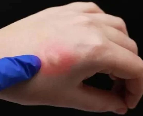 How to Deal with Allergic Reactions to Insect Bites