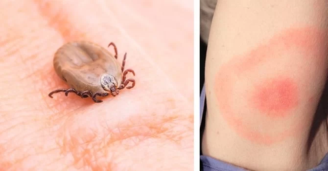 How to Deal with Tick Bites and Lyme Disease Prevention - Expert Tips