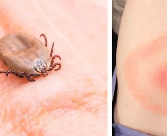 How to Deal with Tick Bites and Lyme Disease Prevention - Expert Tips