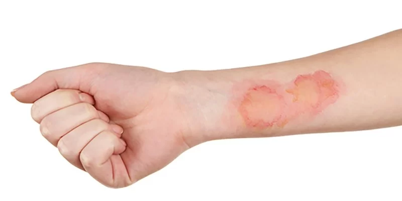 How to Deal with Minor Burns and Scalds While Camping