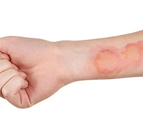 How to Deal with Minor Burns and Scalds While Camping